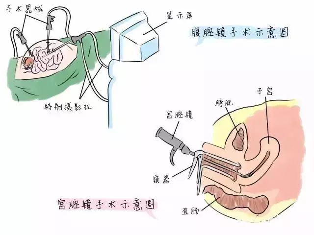 探索子宫腺肌症治疗领域的尖端创新——揭秘最新疗法的突破与进展